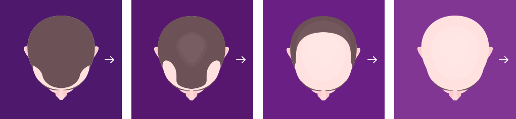Erblich bedingter Haarausfall beim Mann Erblich bedingter Haarausfall beim Mann